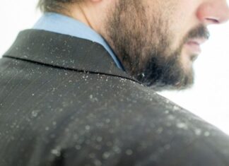 Πιτυρίδα στα μαλλιά – Μήπως ευθύνεται το άγχος;