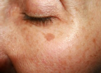 Πανάδες μετά τις διακοπές: Πέντε τρόποι για να τις καταπολεμήσετε