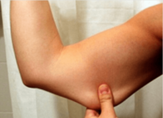 Πως μπορείτε να απαλλαγείτε από το τοπικό λιπος και την χαλάρωση στα μπράτσα