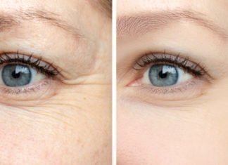 Τι μπορείτε να κάνετε για τις ρυτίδες