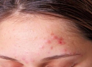 Ο σίγουρος τρόπος για να εξαφανίσεις τα σπυράκια!