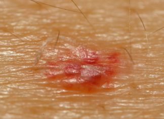 Eλιές στο δέρμα: Πότε βγαίνουν, ποιοι τύποι υπάρχουν και τι να προσέχετε