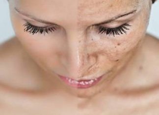 Πανάδες: Γιατί εμφανίζονται και τι να κάνετε