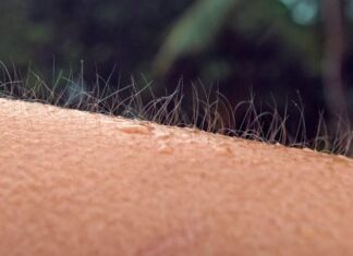 Που οφείλεται η τριχοφυΐα