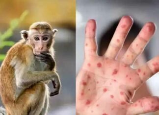 Τι γνωρίζουμε έως τώρα για την ευλογιά των πιθήκων (monkeypox)