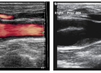 Ερευνητές του ΤΕΠΑΚ συμμετέχουν σε σημαντική δημοσίευση για την αθηροσκλήρωση