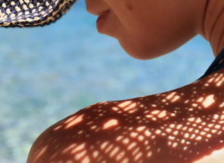 ΠΑΣΥΚΑΦ: Συνολικά 74 περιστατικά μελανώματος του δέρματος στην Κύπρο το 2019