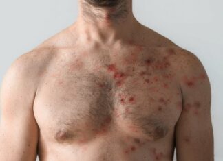 Ευλογιά των πιθήκων: Πώς μπορούμε να προστατευτούμε ;