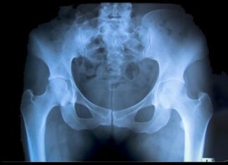 Έρευνα: Αυξημένος ο κίνδυνος κατάγματος στο ισχίο για τις vegan γυναίκες