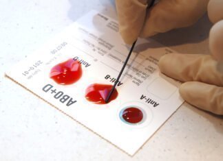 Ποια ομάδα αίματος έχει μεγαλύτερο κίνδυνο για πρώιμο εγκεφαλικό