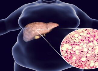 Τι είναι το λιπώδες ήπαρ και με ποια διατροφή θα το μειώσετε