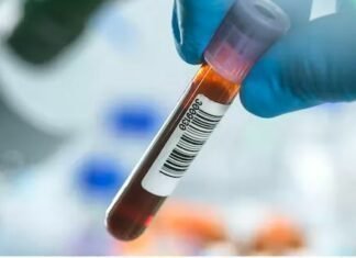 Ο καρκίνος παγκρέατος εξακολουθεί να έχει αυξημένη επίπτωση σε άνδρες και γυναίκες