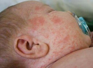 Οστρακιά: Συναγερμός στην Ευρώπη από την αύξηση κρουσμάτων