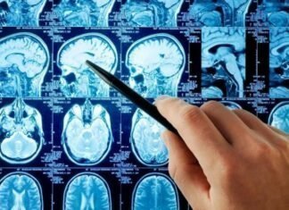 Όλα όσα πρέπει να ξέρετε για το ανεύρυσμα εγκεφάλου μια άκρως επικίνδυνη κατάσταση