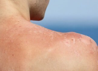 ΠΑΣΥΚΑ: Κάθε 14 δευτερόλεπτα διαγιγνώσκεται ένας καρκίνος δέρματος παγκόσμια