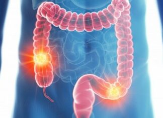 376 νέα περιστατικά καρκίνου του παχέος εντέρου το 2020 στην Κύπρο