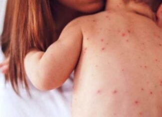 Ανησυχία για τη σταθερή αύξηση περιστατικών ιλαράς – Δύο περιστατικά ιλαράς στην Κύπρο από την αρχή του έτους