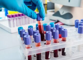 Κλινική δοκιμή νέων τεστ αίματος για τον έγκαιρο εντοπισμό άνοιας