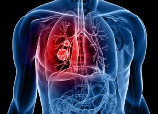 Κύπρος: Δεύτερος σε συχνότητα στους άνδρες ο καρκίνος του πνεύμονα