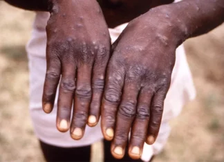 Ευλογία των πιθήκων: Ανησυχία μετά τον παγκόσμιο συναγερμό του ΠΟΥ – Πώς μεταδίδεται