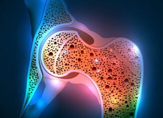 Οστεοπόρωση: Μια Σιωπηλή Απειλή για τα Οστά