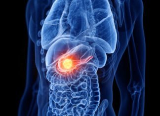 Έβδομος συχνότερος σε άνδρες και 8ος σε γυναίκες στην Κύπρο ο καρκίνος παγκρέατος