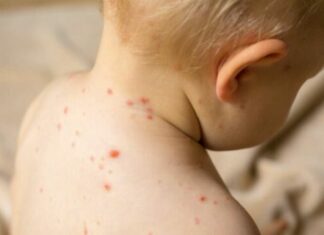 Σε καραντίνα τα ανεμβολίαστα κρούσματα ιλαράς, όλα από το ίδιο νηπιαγωγείο